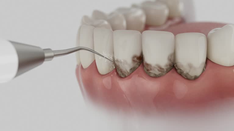Trusted Wisdom Tooth Removal service in Blacksburg, SC - Dentist Open Now